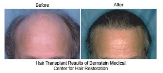 New york women's hair loss treatment options. Hair Transplant Pioneer Named Best Doctor In New York Magazine For 10th Consecutive Year Ahb