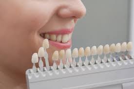 Coroana metalo ceramica este una dintre cele mai accesate solutii de catre pacientii care au unul sau mai multi dinti lipsa si care isi doresc un tratament cu un coroana metalo ceramica este o coroana fizionomica (invelisul ceramic prezent pe toate fetele simuleaza destul de exact textura si nuantele. Alegerea Culorii RestaurÄƒrilor Dentare De Ce Este ImportantÄƒ È™i Cum Se RealizeazÄƒ