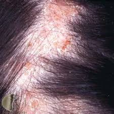 Uregelmessig form, ujevn yttergrense, varierer i farge. Soppinfeksjon I Hodebunnen Oslo Hudlegesenter