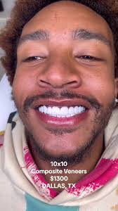 Best Composite Veneers in Dallas, TX for $1300