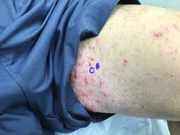 Image result for scabies in the groin area