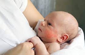 Piel De Mariposa Una Enfermedad Cutanea Poco Conocida Letsfamily