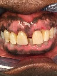 Black Gums Dark Gums Loop Perio black gums dark gums loop perio