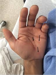 Learn how to spot the sores, rashes, and signs of the disease. Syphilis As Athlete S Foot The Great Imitator Strikes Again Springerlink