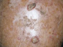 Image result for cornu cutaneum)