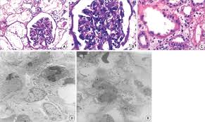 Ems is committed to providing the highest quality products along with. The Renal Biopsy Specimen On Light Microscopy Showed Proliferative Download Scientific Diagram