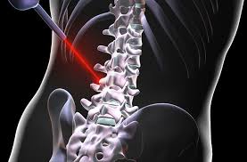We did not find results for: Can Laser Spine Surgery Fix Your Back Pain Cleveland Clinic