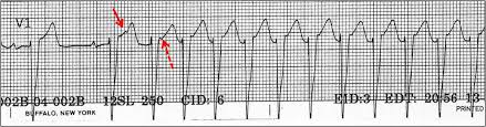 Characteristic ecg findings in wpw are observed due to the accessory pathway activating the ventricle slightly. Ecg Learning Center An Introduction To Clinical Electrocardiography