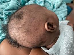 Image result for white scabs on the head in children