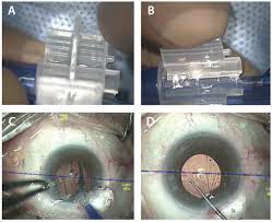 What does it stands for in category governmental. Crsteurope Multifocal And Trifocal Lenses In Post Lasik Eyes