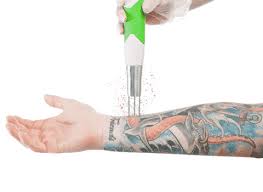 The laser that is being used is also a huge factor in how many sessions will be needed. How Many Sessions Of Laser Tattoo Removal Will I Need