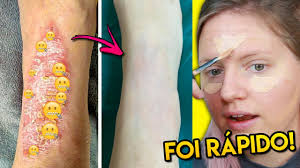 There are many ways to treat psoriasis, and your treatment plan will depend on the type of disease and how. Maquia E Fala Curei Meu Machucado Do Meu Pe Adeus Psoriase Youtube