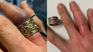 Image result for Ring Removal