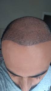 Clinicexpert 4000 Gref