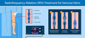 Image result for Radiofrequency Surgery