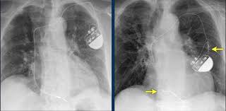 Learn vocabulary, terms and more with flashcards, games and other study terms in this set (83). The Radiology Assistant Cardiovascular Devices