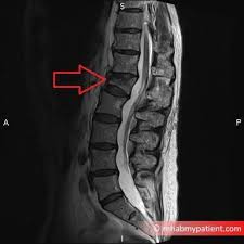 There are various types of fractures: Anterior Wedge Fracture To The Vertebra Rehab My Patient