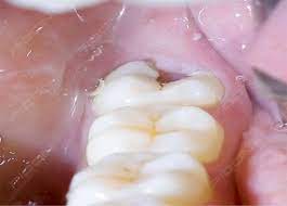 Management Of Pericoronitis Using Dental Diode Laser Dental Laser Medical Dental Dental