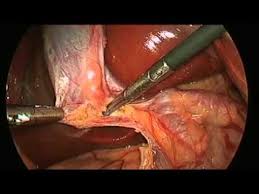 Laparoscopic Cholecystectomy Gallbladder Surgery Coconut Health Benefits Gallbladder Surgery Health