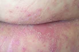 Image result for Candidiasis