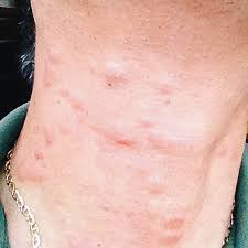 Image result for Fire Ant Sting