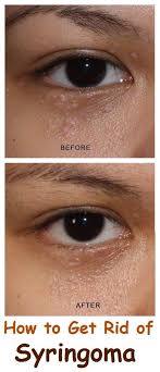 Biossance Squalane Marine Algae Eye Cream Reddit How To Get Rid Of Syringoma Skin Bumps Vaseline Beauty Tips Bumps Under Eyes