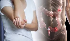 Bowel cancer is the third leading cause of cancer in the u.s. Bowel Cancer Symptoms Swollen Hands And Feet Could Be A Sign Of The Deadly Condition Express Co Uk