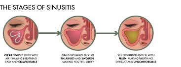 Check spelling or type a new query. How To Sleep With Sinusitis Sinusitis And Sleep Woolroom