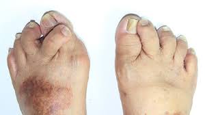 Image result for foot fingers