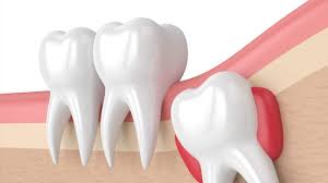 Possible complications include dry socket (alveolar osteitis), infection, bleeding. Should Painless Wisdom Teeth Be Removed Blue Island Smiles