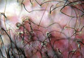 Image result for koebner phenomenon psoriasis