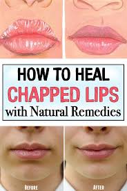 How To Heal Chapped Lips With Natural Remedies Dry Lips Remedy Treating Chapped Lips Chapped Lips Remedy