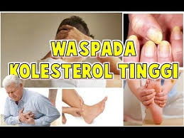 Namun apakah tanda kolesterol bisa dirasakan? Inilah Tanda Tanda Kolesterol Tinggi Yang Wajib Diwaspadai Health Info Tanda Info