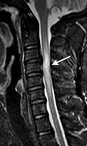 The internet backbone may be defined by the principal data routes between large, strategically interconnected computer networks and core routers of the internet. Diagnostic Approach To Intrinsic Abnormality Of Spinal Cord Signal Intensity Radiographics