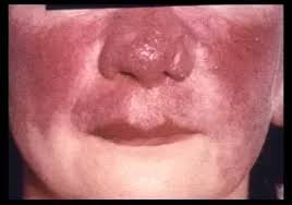 We did not find results for: What Is Lupus Pernio Quora