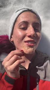 Skincare in the snow☃️ Pimple patches come off easily when they’re already  peeling! No pulling at the skin this way! #pimplepatches  #pimplepatchresults #pimplepatch