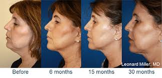 ThermiTight Skin Tightening • Osman Dermatology