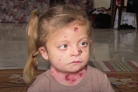 Genocide in Gaza triples the suffering ...
