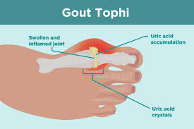 What Are Gout Tophi Causes Symptoms And Treatments A flare is a transient worsening in severity of a disease or condition that eventually.