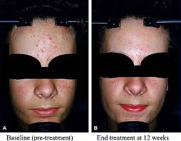 New insights into the management of acne: An update from the Global  Alliance to Improve Outcomes in Acne Group