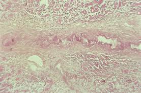 Martorell ulcers affect women more commonly than men. Ulcus Hypertensivum Van Martorell