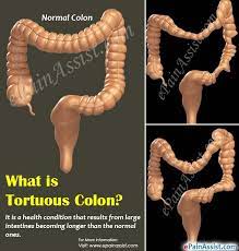 Pin On Abdominal Pain Or Stomach Pain