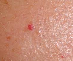 Cherry angiomas are often bright red and can grow to resemble smooth domes with flat tops. Cherry Angiomas An Esthetician S Guide