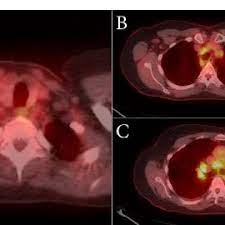 Sarcoidosis is a disease involving abnormal collections of inflammatory cells that form lumps known as granulomata. Pdf Lung Cancer Or Sarcoidosis A Diagnostic Dilemma