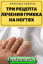 как вылечить грибок на ногах в домашних условиях видео Tri Recepta Lecheniya Gribka Na Nogtyah Zdorove Recepty Bolezn Lechit In 2020 Health And Beauty Natural Health Helpful Hints