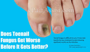 Be it a toenail fungus or fingernail fungus, it is very painful and embarrassing to deal with it. Does Toenail Fungus Get Worse Before It Gets Better