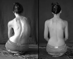 This Is My Back Before And After Surgery I Am Fused T3 L4 Scoliosis Surgery Scoliosis Scoliosis Brace