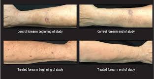 Image result for Pigment stains on the shin