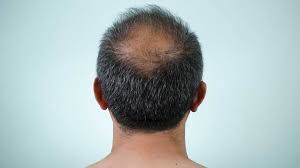 It can be caused by a number of factors and can be a symptom of an underlying medical condition. Scalp Conditions Pictures Causes And Treatments