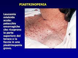 Questa survey nasce da una iniziativa in ambito aisf promossa dai dott. Leucemie Sono Tumori Maligni Del Sistema Emolinfopoietico Ppt Scaricare